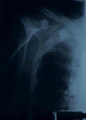 Clavicle Xray 008 Clavicle & Dislocated Shoulder