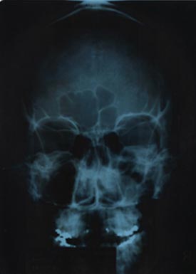 Xray-head-003 Brain lesions and fractured mandible